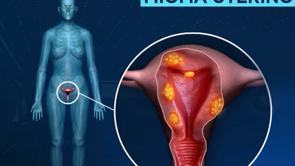 tratamento de miomas